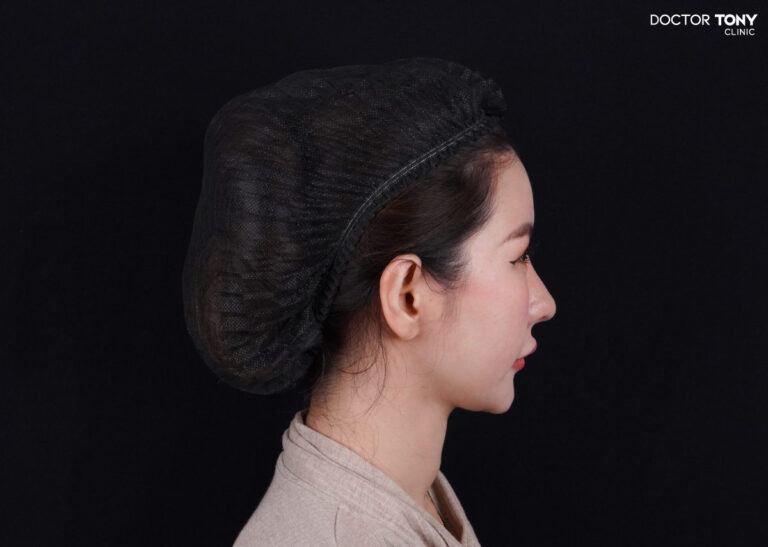 หน้าผากแบน