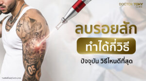 ลบรอยสัก