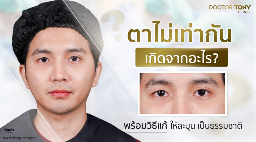 ตาไม่เท่ากัน