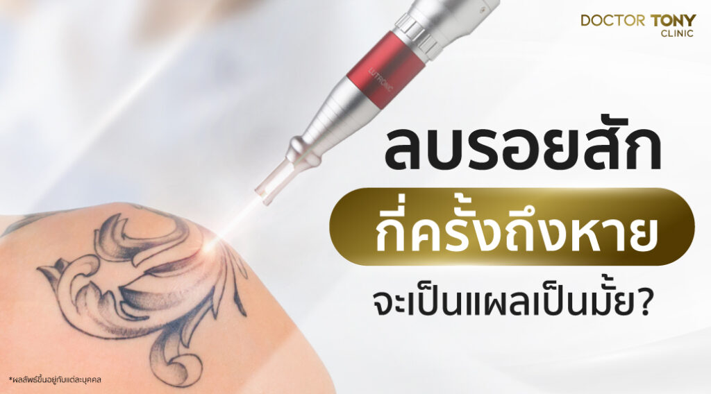 เลเซอร์รอยสักกี่ครั้งหาย