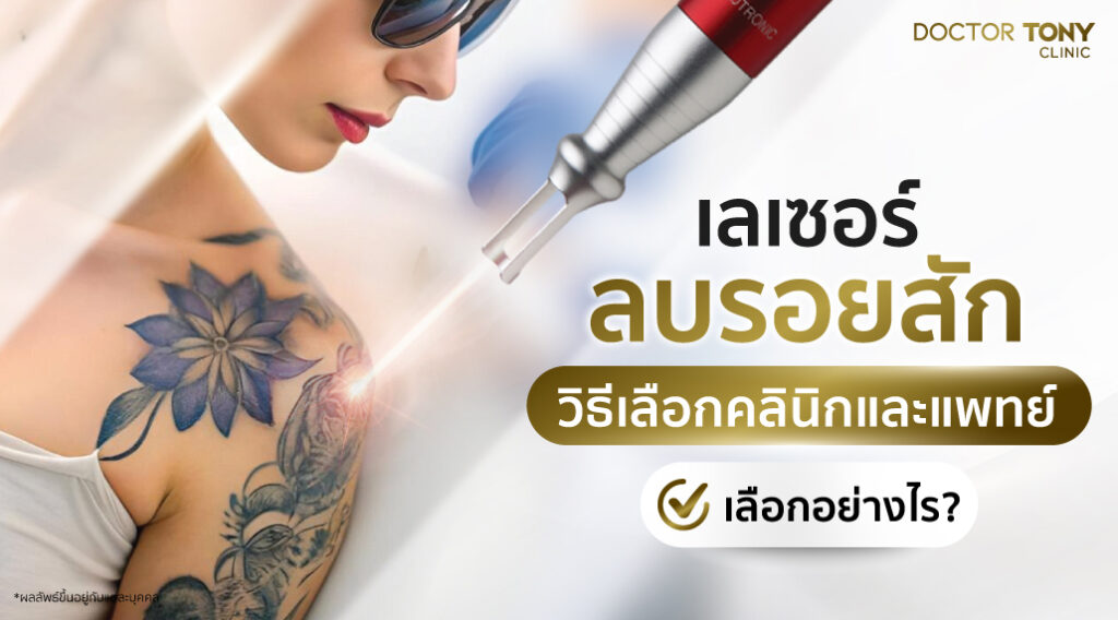 เลเซอร์ลบรอยสัก