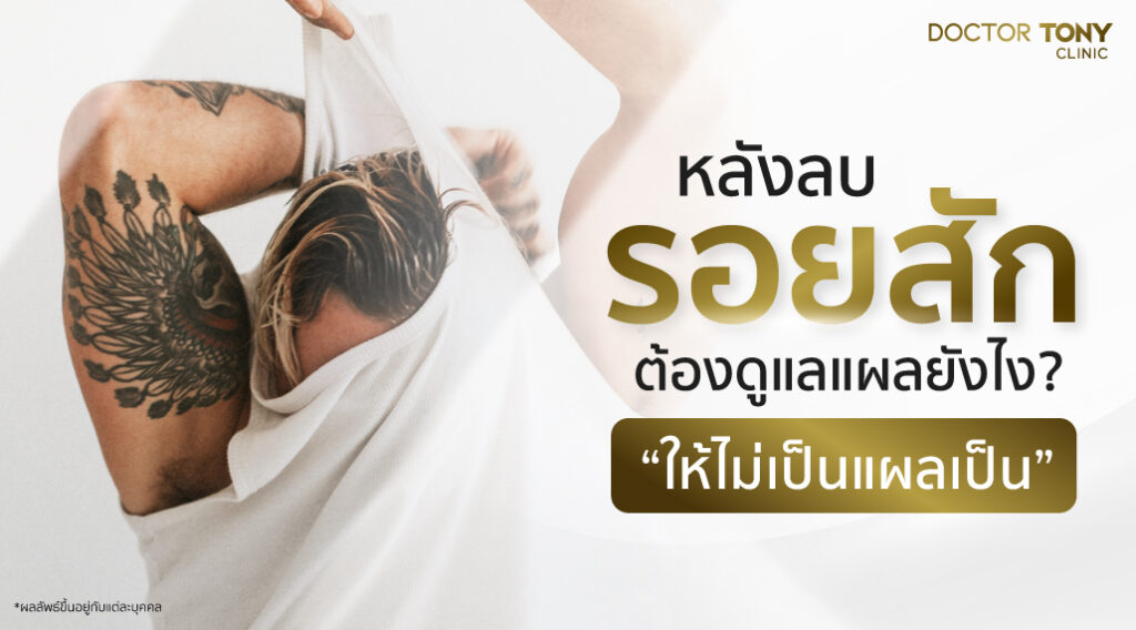 หลังลบรอยสัก