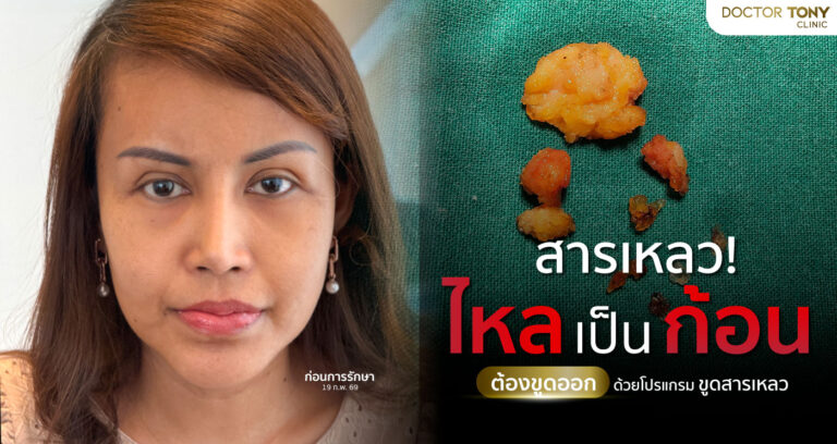 ฟิลเลอร์ปลอม