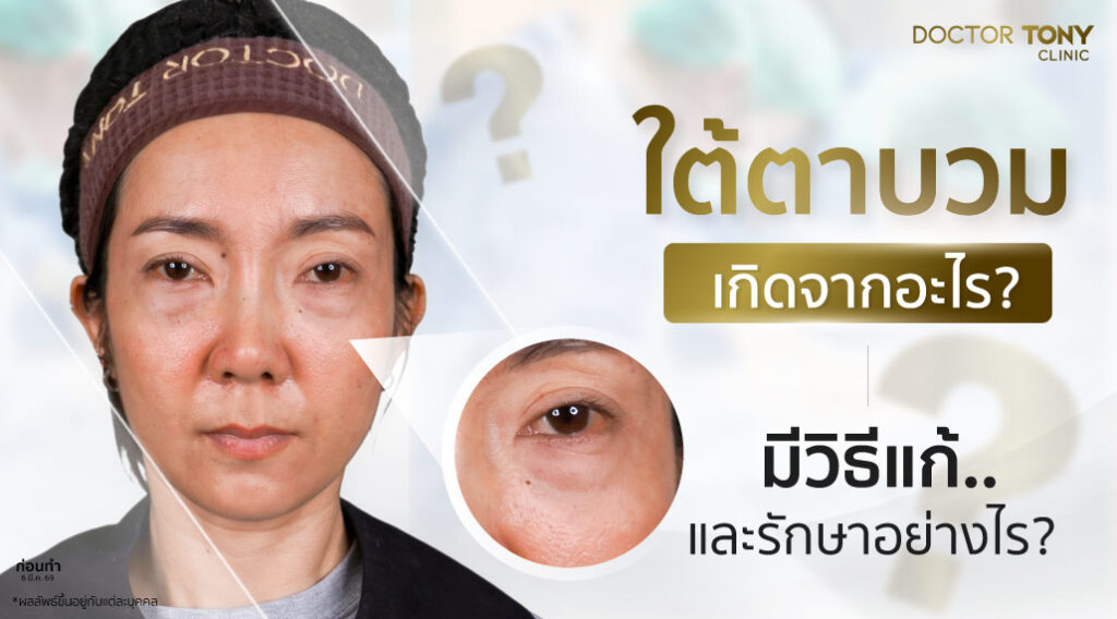 ใต้ตาบวม