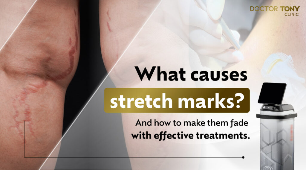 Stretch Marks